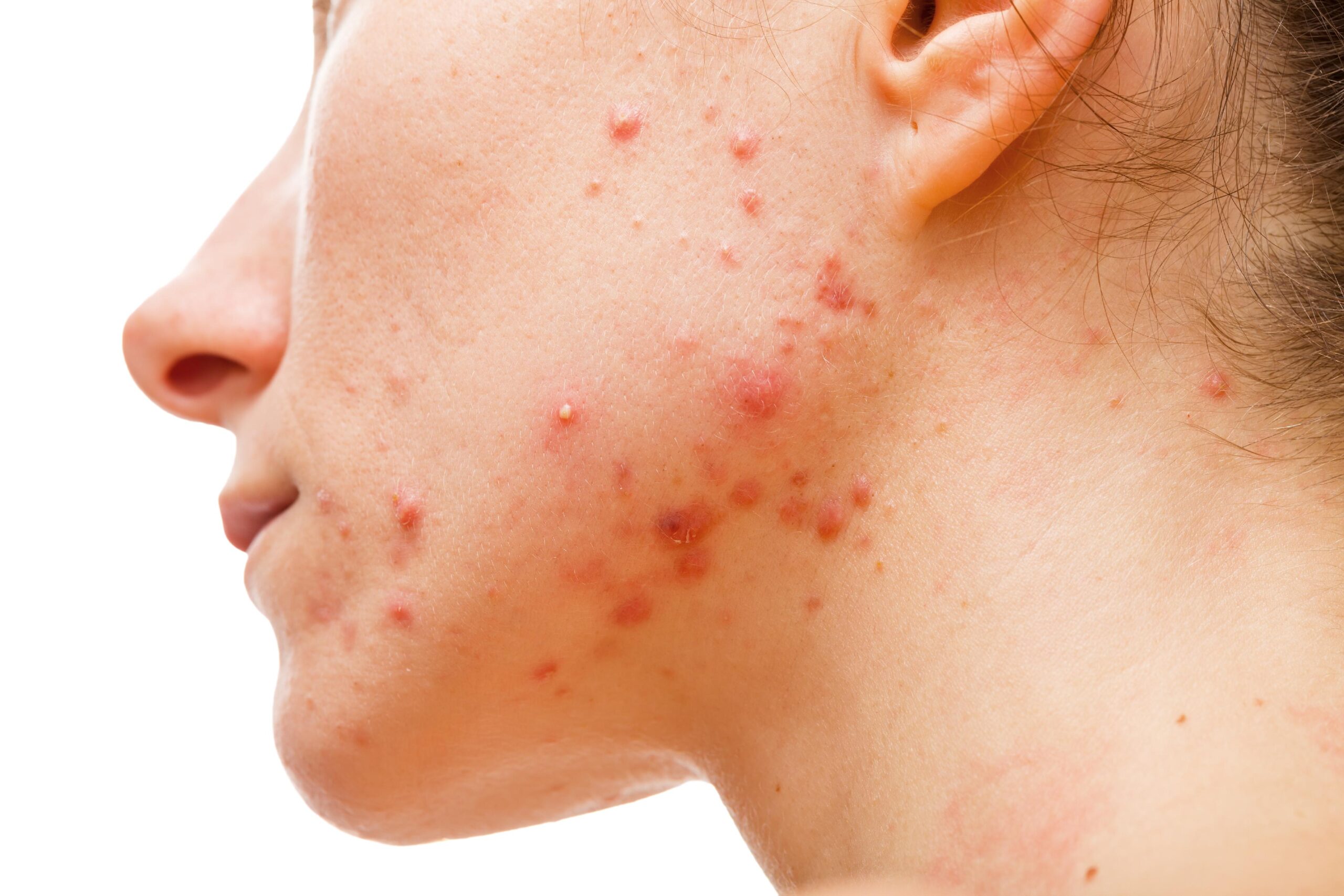 Inflamed Acne